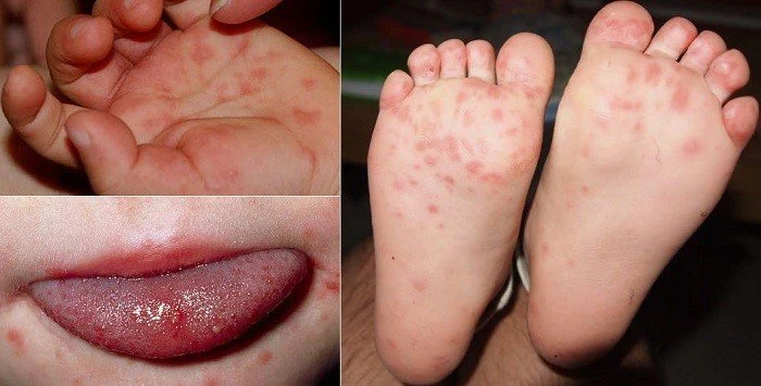 Thanh Hóa: Trời nắng hanh, cần đề phòng các bệnh trong thời điểm giao mùa