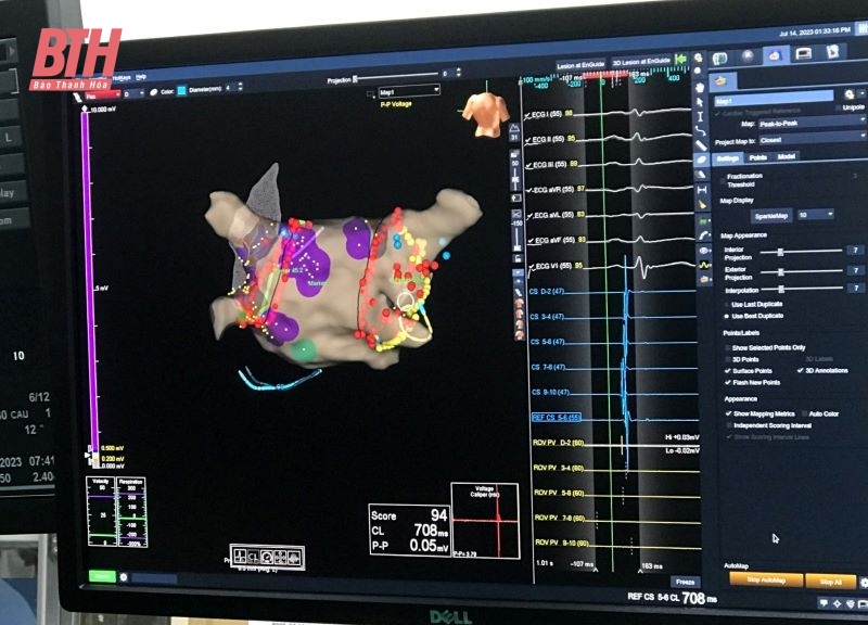 Bệnh viện tuyến tỉnh đầu tiên triển khai thành công kỹ thuật triệt đốt rung nhĩ bằng sóng radio sử dụng hệ thống lập bản đồ 3D