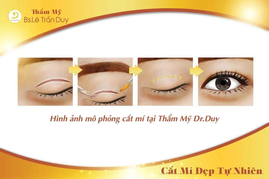 Cắt mí mắt đẹp chưa đến 50 phút ở bác sĩ giỏi