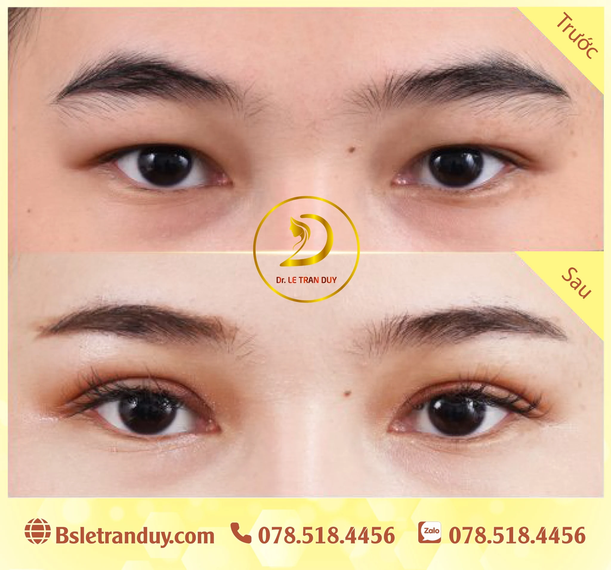 Cắt mí mắt đẹp chưa đến 50 phút ở bác sĩ giỏi