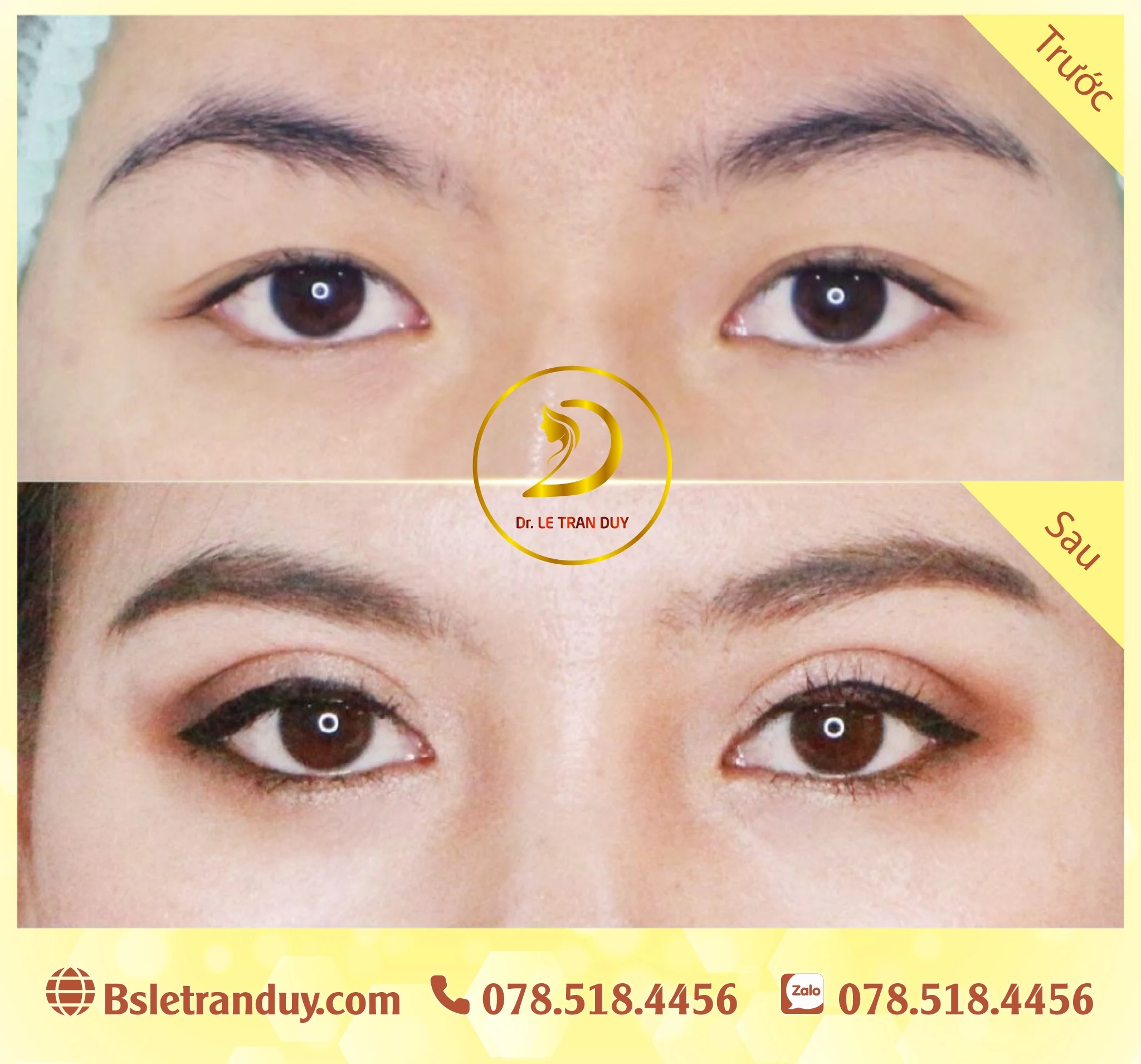 Cắt mí mắt đẹp chưa đến 50 phút ở bác sĩ giỏi