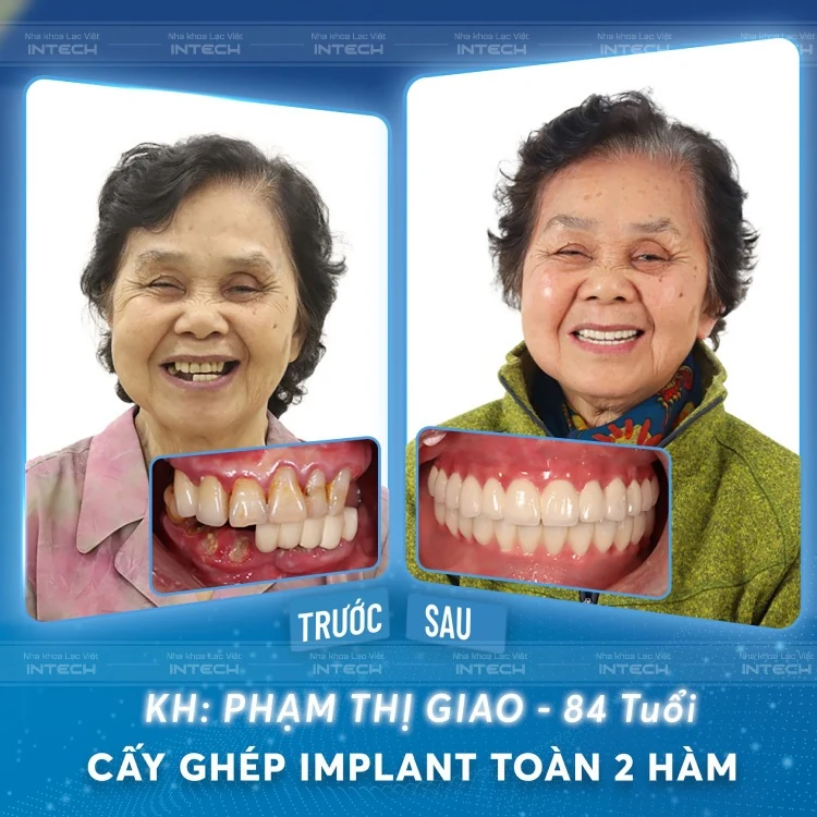 Nha khoa Lạc Việt Intech chia sẻ những ưu điểm của trồng răng Implant all on 4