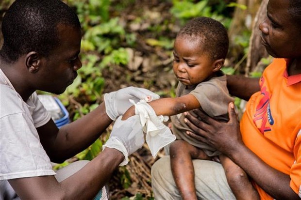 CDC châu Phi kêu gọi không tích trữ vaccine để đối phó đậu mùa khỉ