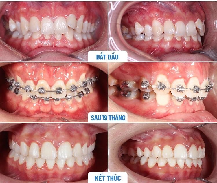 Giai đoạn xấu nhất khi niềng răng là lúc nào? Làm thế nào để cải thiện tình trạng hóp má?