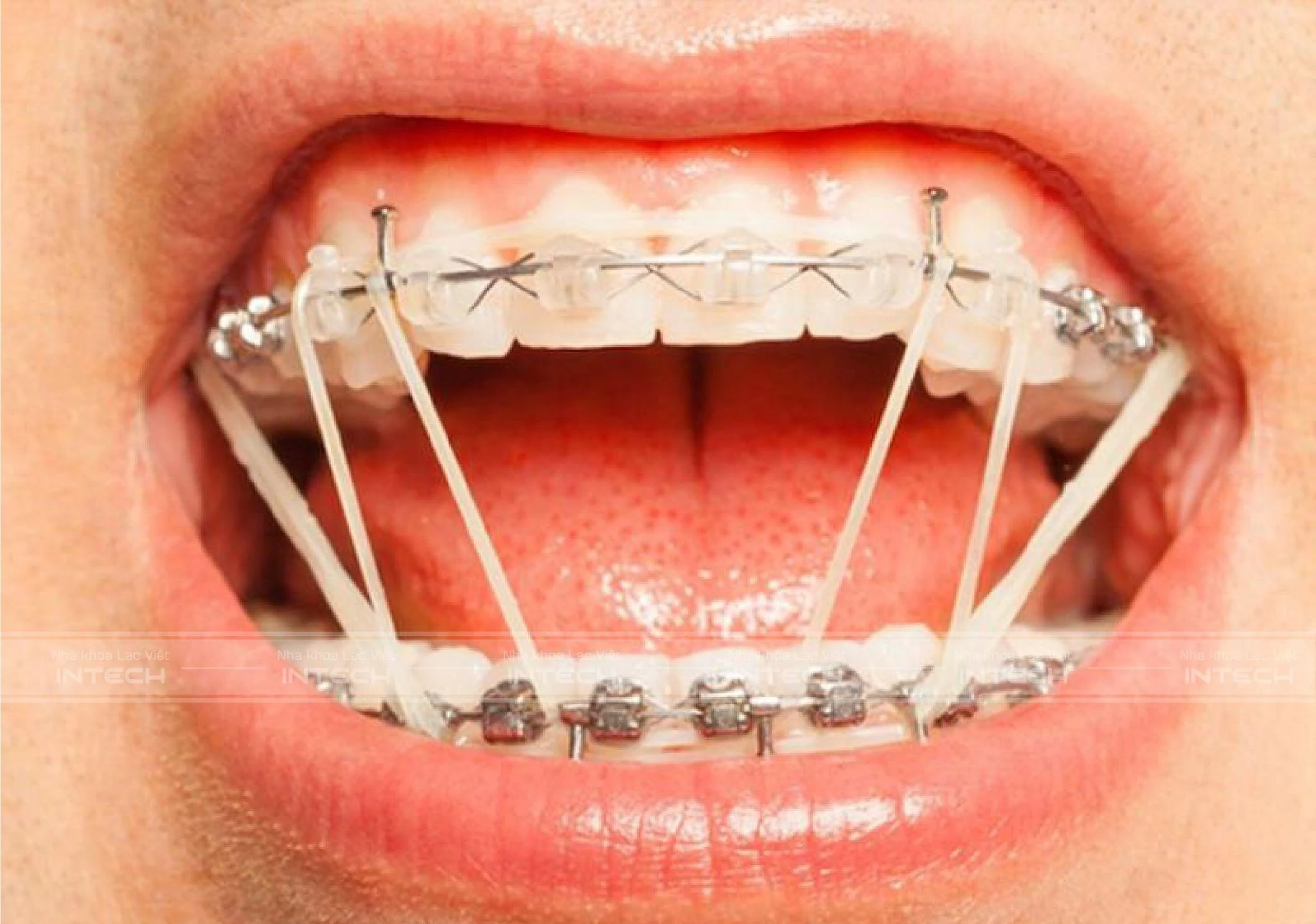 Giai đoạn xấu nhất khi niềng răng là lúc nào? Làm thế nào để cải thiện tình trạng hóp má?