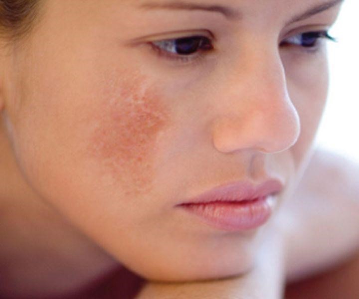 7 lý do khiến nám nhanh tái phát và lời khuyên của Lasmar giúp điều trị dứt điểm