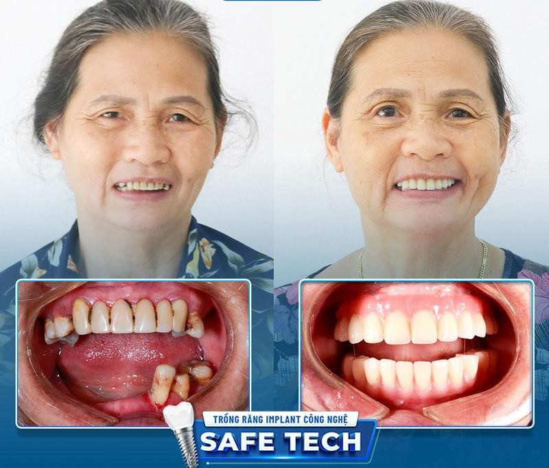 Trồng răng All-on-4, All-on-6: Giải pháp tối ưu cho người mất răng toàn hàm