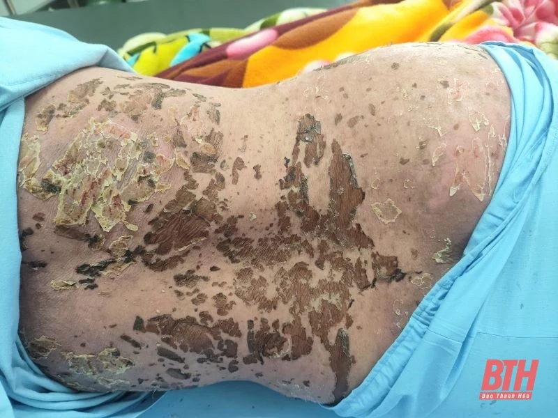 Suýt mất mạng vì sử dụng thuốc nam không rõ nguồn gốc gây ra hội chứng Lyell