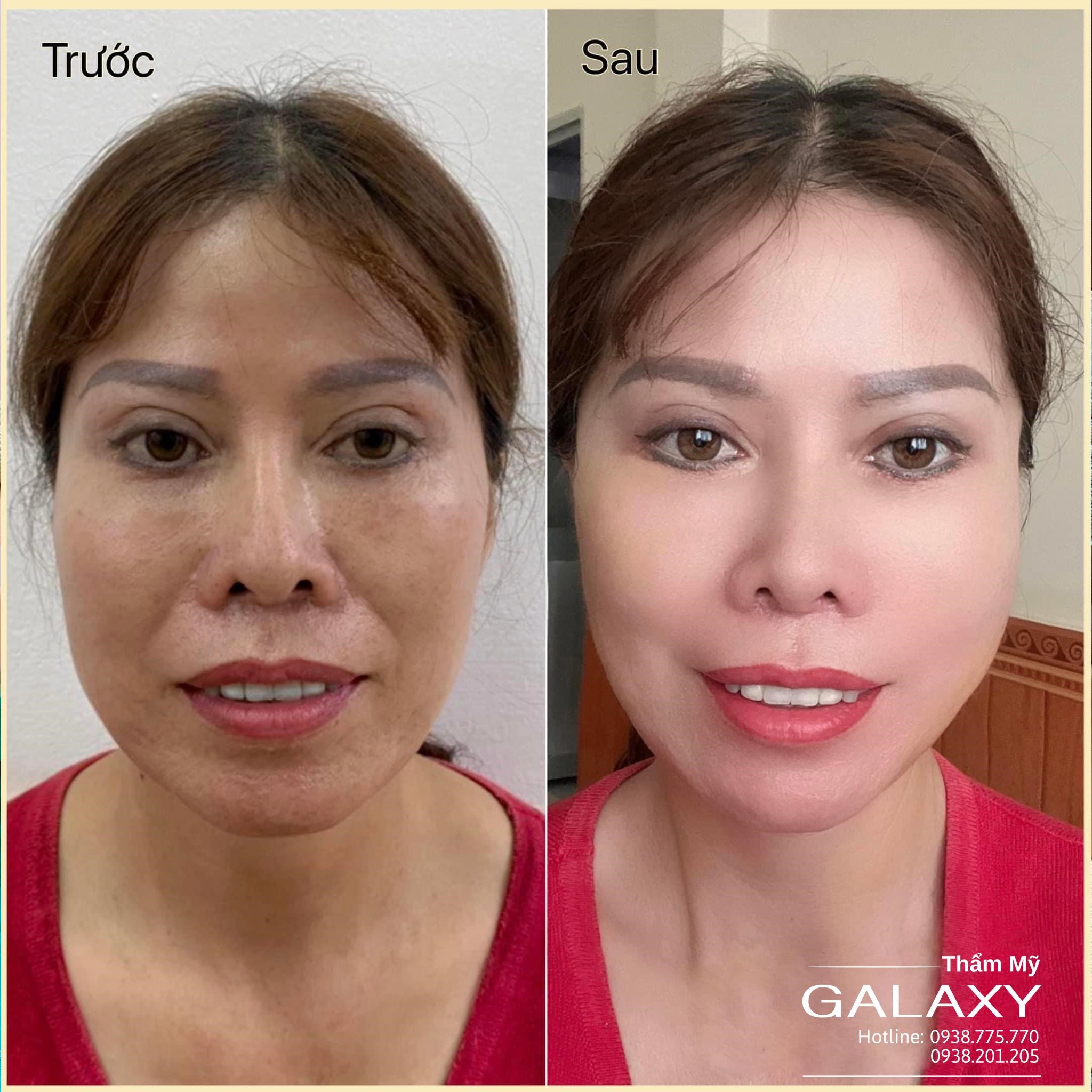 Căng da mặt đẹp cùng chuyên gia hàng đầu