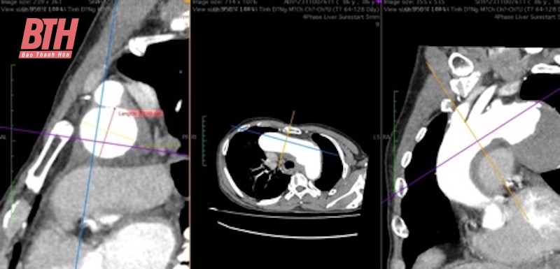 Kết hợp kỹ thuật can thiệp và phẫu thuật cứu sống bệnh nhân 86 tuổi mắc bệnh lý tim mạch phức tạp