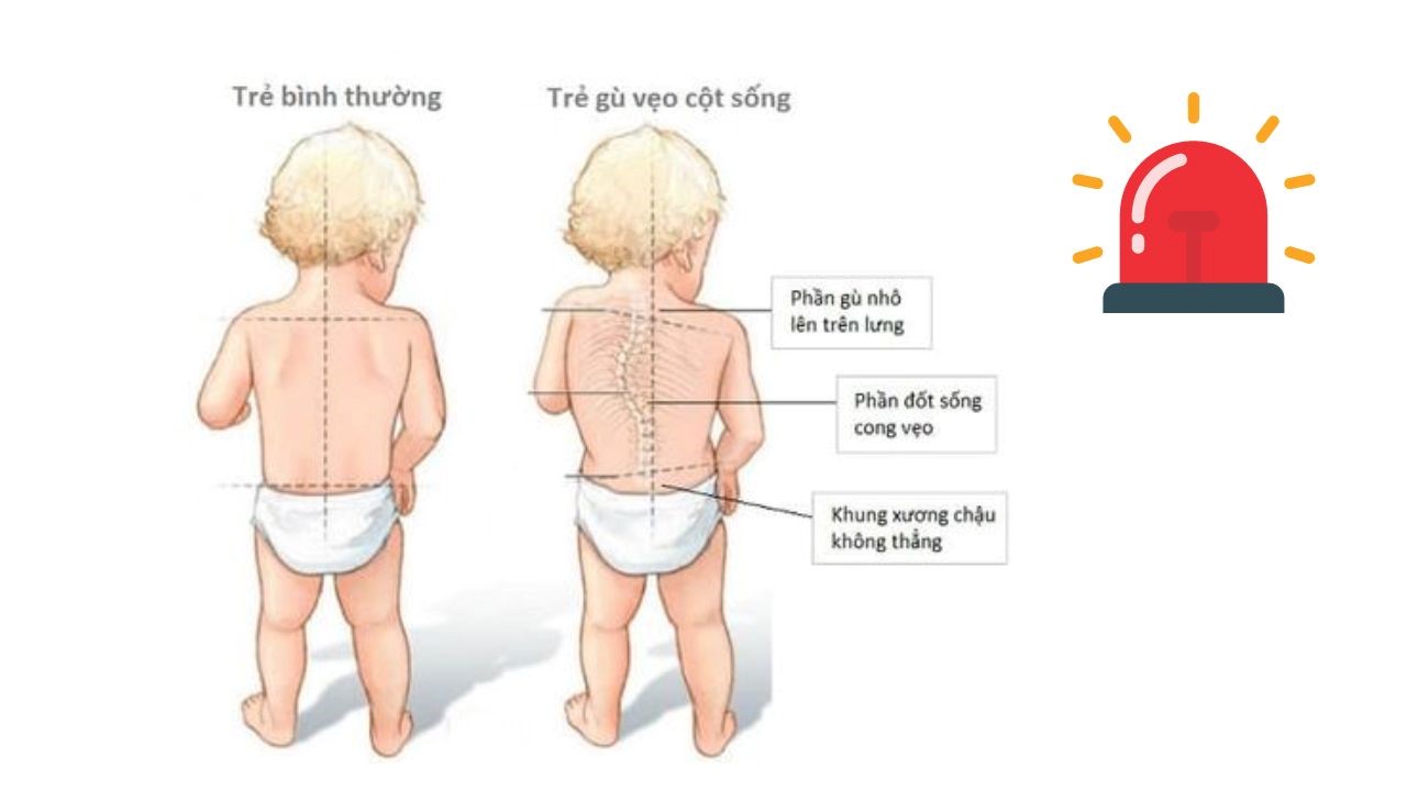 Phòng tránh gù lưng ở trẻ nhỏ: Tầm quan trọng của bàn ghế chống gù