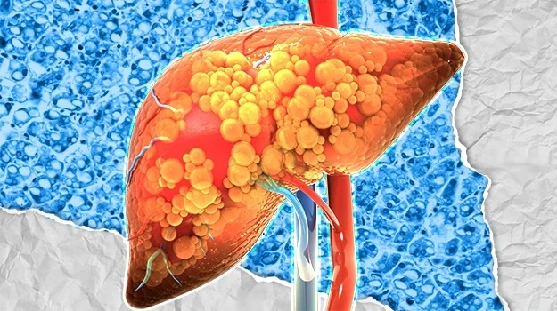 FDA Mỹ phê duyệt thuốc đầu tiên chữa viêm gan nhiễm mỡ không do rượu