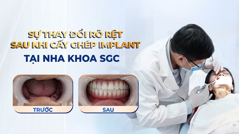 Nha Khoa SGC - địa chỉ uy tín trồng răng Implant tại TP Hồ Chí Minh