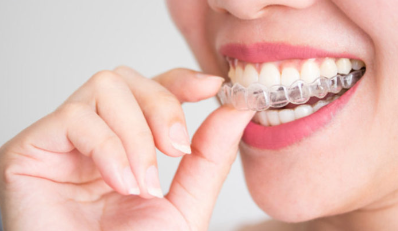 Quy trình niềng răng trong suốt Invisalign gồm mấy bước?