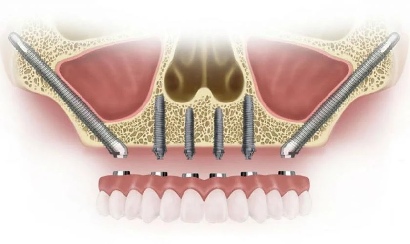 Trồng răng implant có đau không? Sau khi trồng răng, bao lâu thì mới có thể sử dụng tốt?