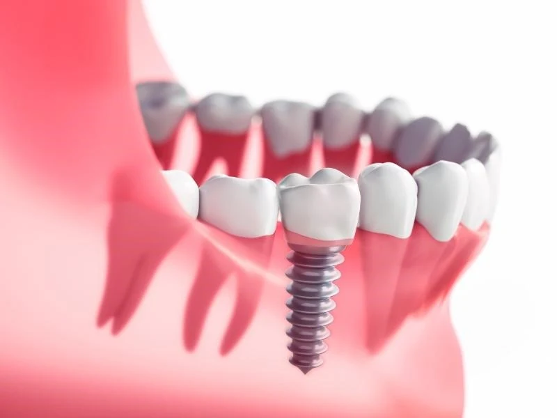 Trồng răng implant có đau không? Sau khi trồng răng, bao lâu thì mới có thể sử dụng tốt?