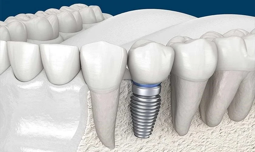 Trồng răng implant có đau không? Sau khi trồng răng, bao lâu thì mới có thể sử dụng tốt?