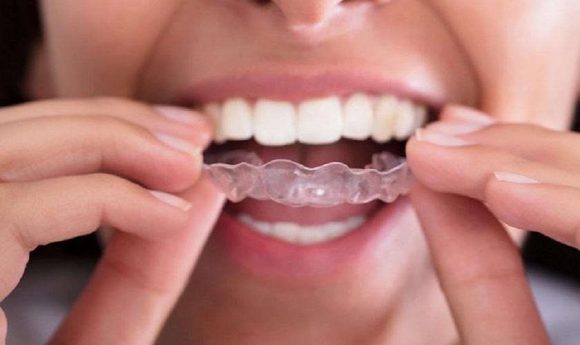 Giá niềng răng trong suốt hiện nay như thế nào?