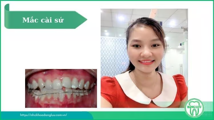 Có nên niềng răng tại Nha Khoa Đăng Lưu hay không?