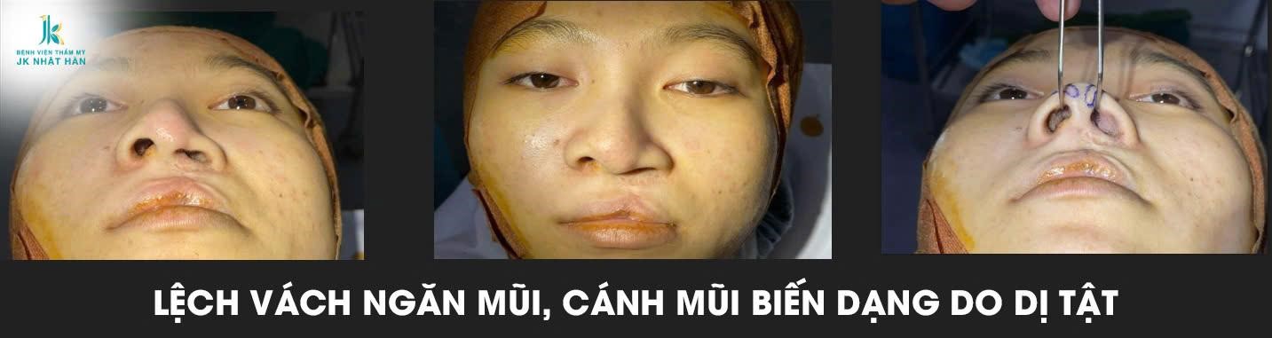 Ứng dụng kỹ thuật V-Y-Z trong tạo hình mũi dị tật