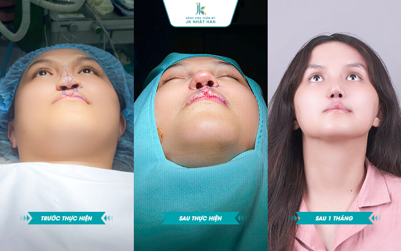 Ứng dụng kỹ thuật V-Y-Z trong tạo hình mũi dị tật