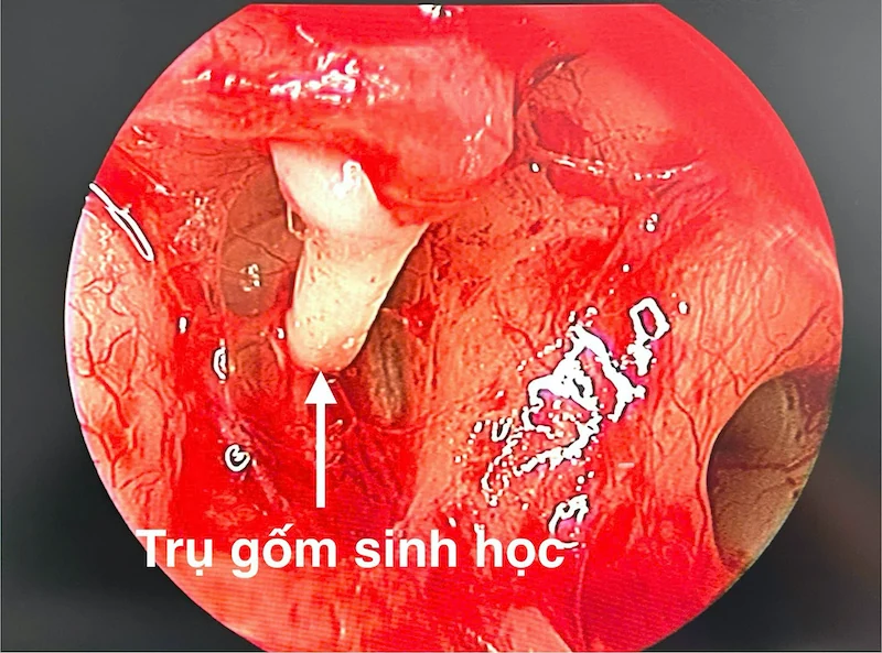 Phẫu thuật nội soi cấy ghép trụ gốm sinh học thay thế xương con tai giữa
