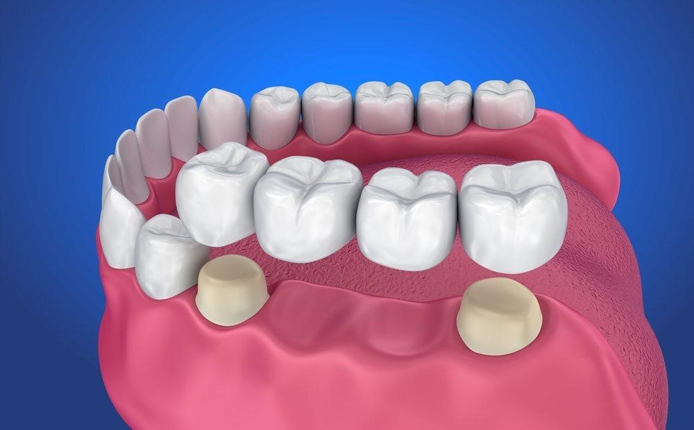 Mất răng nên cấy ghép implant hay làm cầu răng sứ thì tốt?