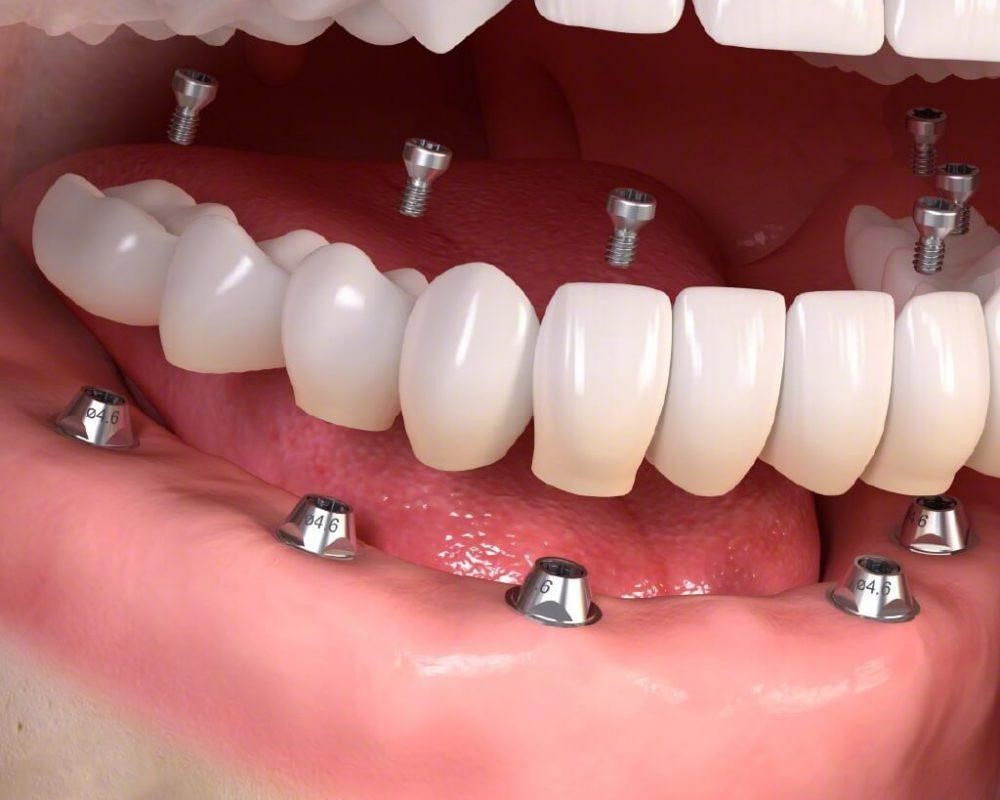 Mất răng nên cấy ghép implant hay làm cầu răng sứ thì tốt?