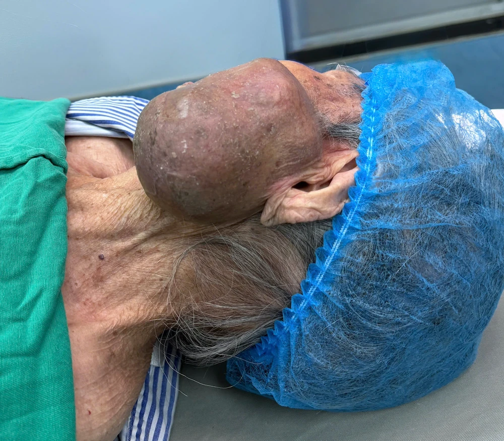 Bệnh viện Ung bướu Thanh Hóa phẫu thuật thành công khối ung thư khổng lồ vùng mặt cho cụ bà 99 tuổi
