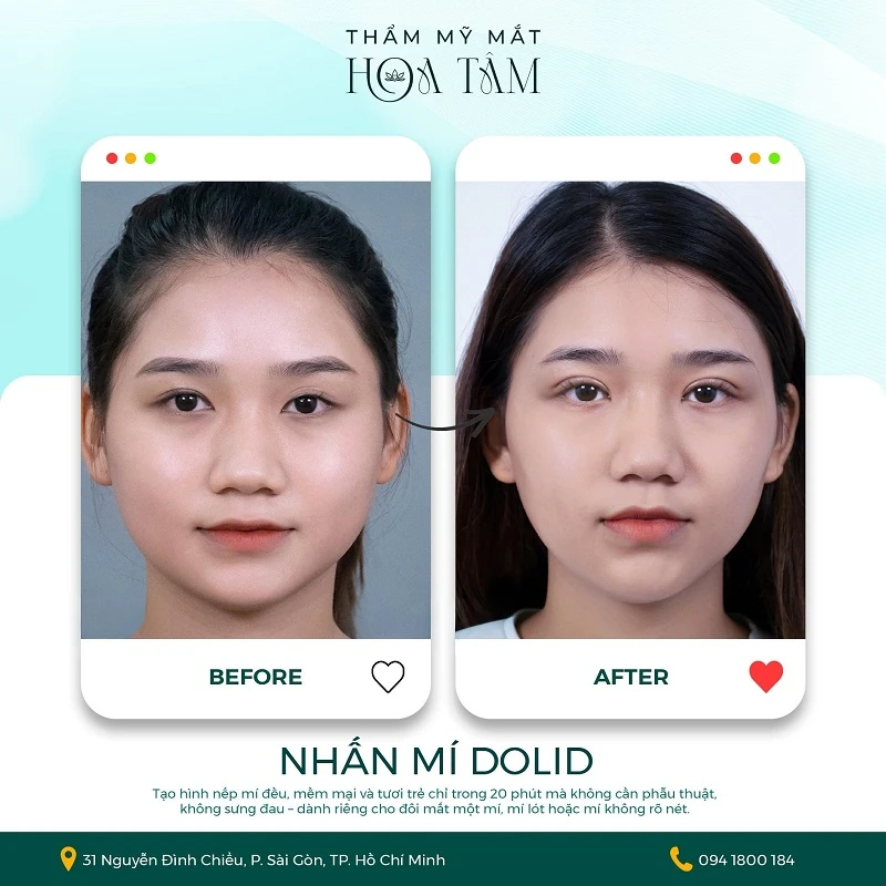 20 năm phát triển thẩm mỹ làm đẹp và phát triển chuyên sâu thẩm mỹ mắt